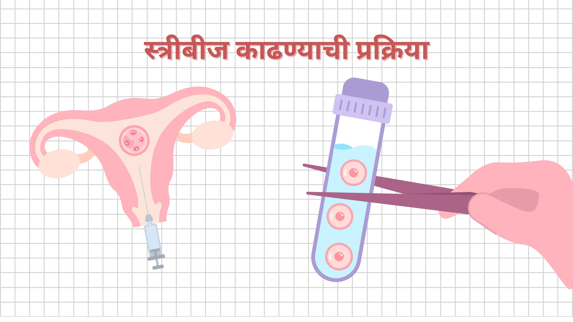 स्त्रीबीज काढण्याची प्रक्रिया
